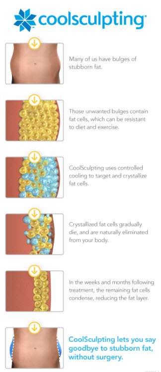 Reasons to choose Coolsculpting, Lose Stubborn Fat